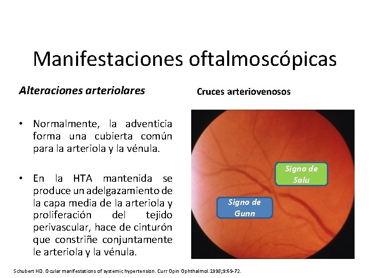 Manifestaciones oftalmoscópicas Alteraciones arteriolares Cruces arteriovenosos • Normalmente, la adventicia forma una cubierta común