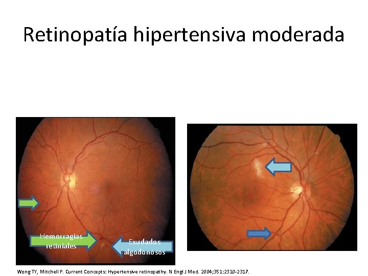 Retinopatía hipertensiva moderada Hemorragias retiniales Exudados algodonosos Wong TY, Mitchell P. Current Concepts: Hypertensive