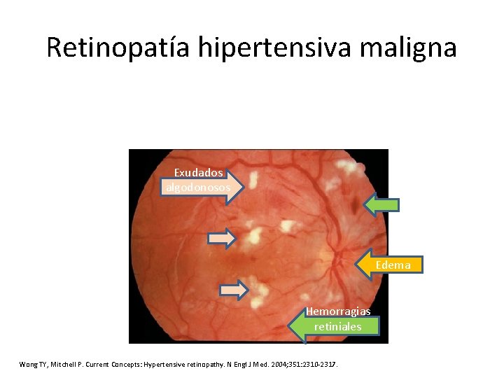 Retinopatía hipertensiva maligna Exudados algodonosos Edema Hemorragias retiniales Wong TY, Mitchell P. Current Concepts: