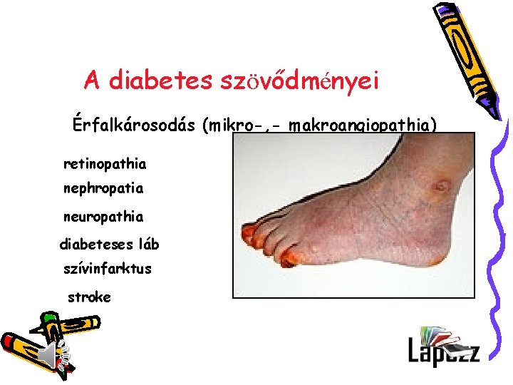 A diabetes szövődményei Érfalkárosodás (mikro-, - makroangiopathia) retinopathia nephropatia neuropathia diabeteses láb szívinfarktus stroke