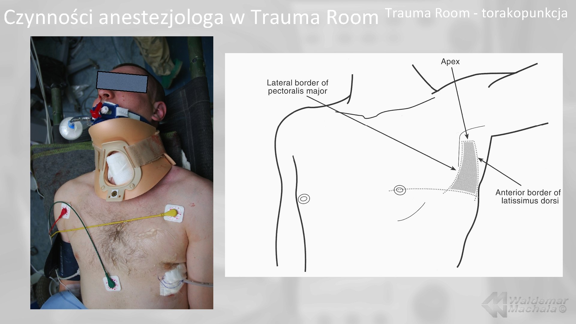 Czynności anestezjologa w Trauma Room - torakopunkcja 