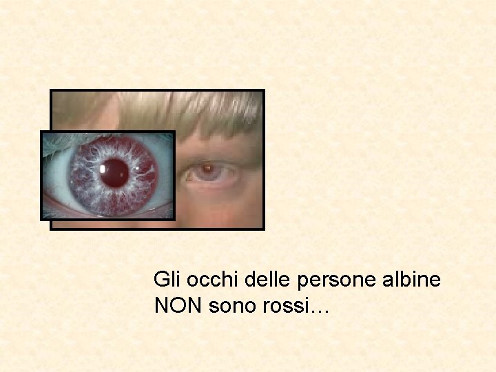 Gli occhi delle persone albine NON sono rossi… 