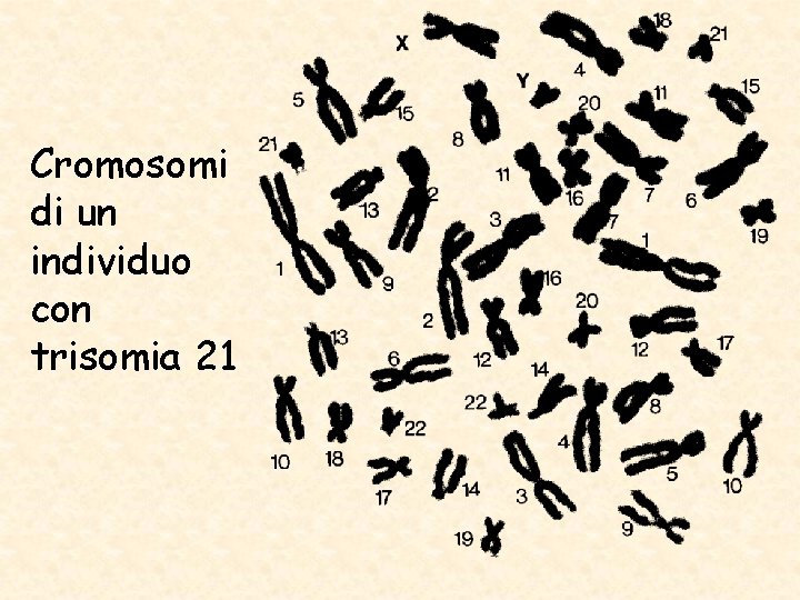 Cromosomi di un individuo con trisomia 21 