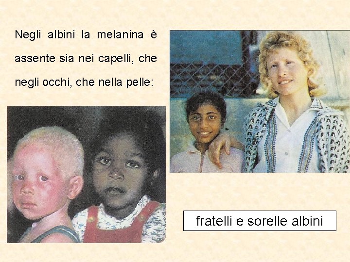 Negli albini la melanina è assente sia nei capelli, che negli occhi, che nella