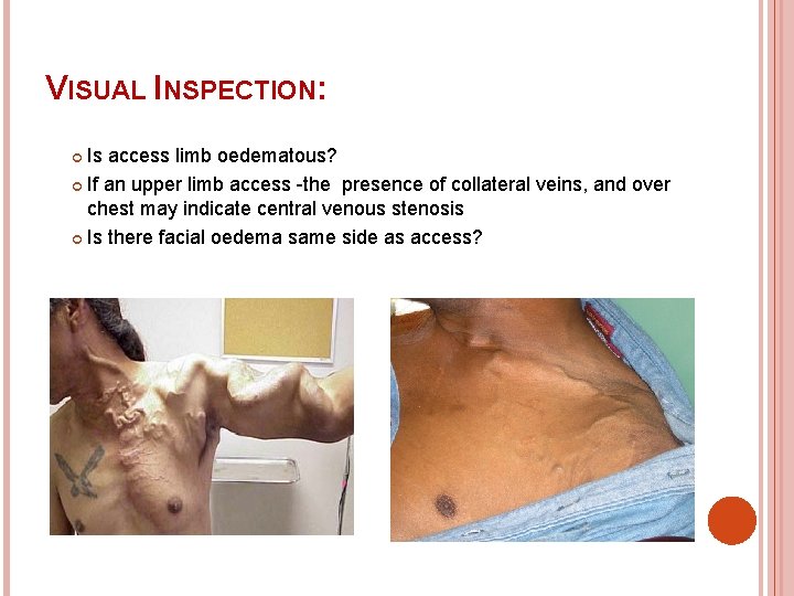 VISUAL INSPECTION: Is access limb oedematous? If an upper limb access -the presence of