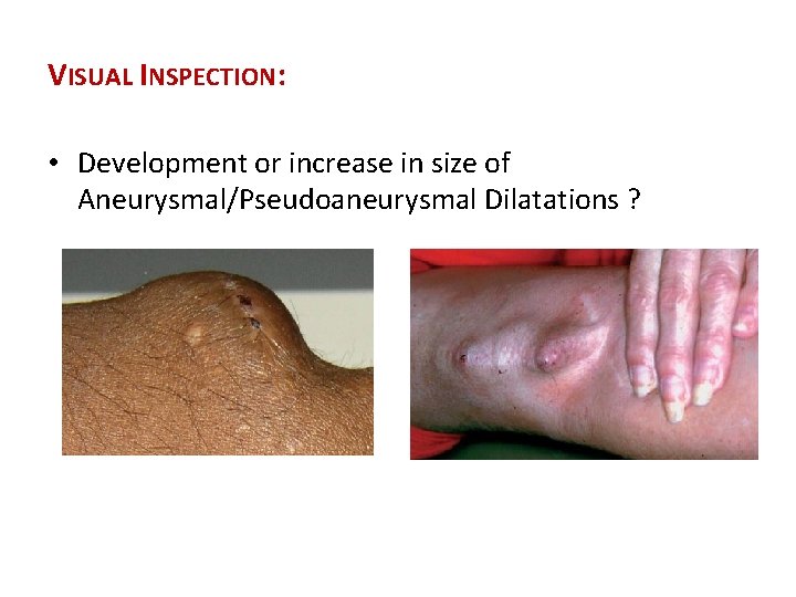 VISUAL INSPECTION: • Development or increase in size of Aneurysmal/Pseudoaneurysmal Dilatations ? 