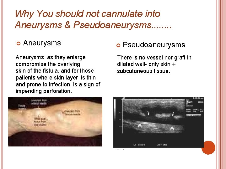 Why You should not cannulate into Aneurysms & Pseudoaneurysms. . . . Aneurysms as