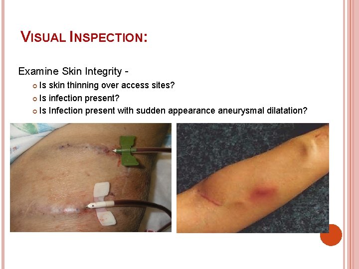 VISUAL INSPECTION: Examine Skin Integrity Is skin thinning over access sites? Is infection present?