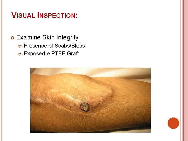 VISUAL INSPECTION: Examine Skin Integrity Presence of Scabs/Blebs Exposed e PTFE Graft 