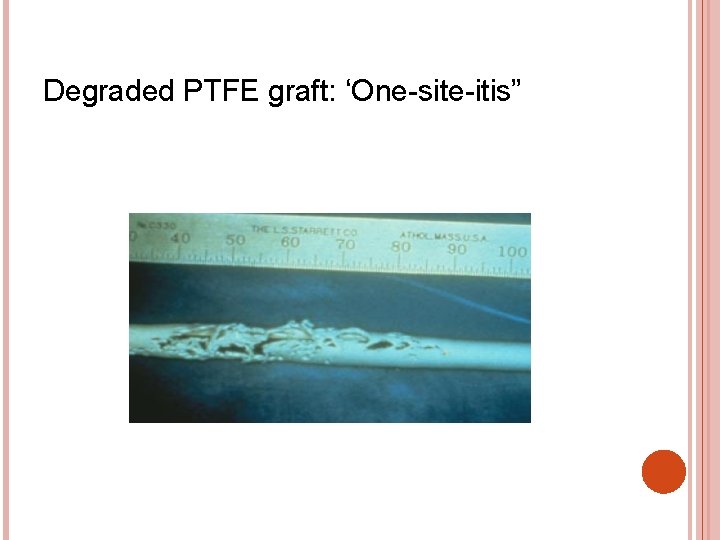 Degraded PTFE graft: ‘One-site-itis” 