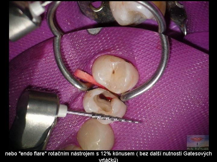 nebo "endo flare" rotačním nástrojem s 12% kónusem ( bez další nutnosti Gatesových vrtáčků)