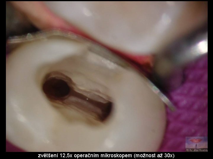 zvětšení 12, 5 x operačním mikroskopem (možnost až 30 x) 