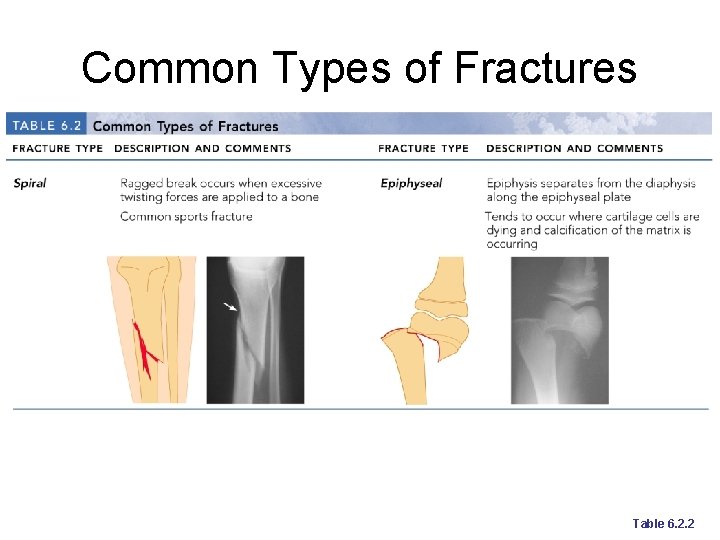 Common Types of Fractures Table 6. 2. 2 