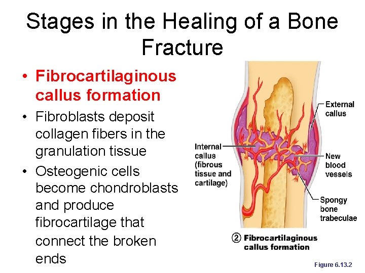 Stages in the Healing of a Bone Fracture • Fibrocartilaginous callus formation • Fibroblasts