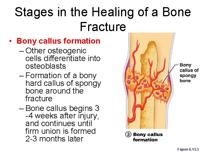 Stages in the Healing of a Bone Fracture • Bony callus formation – Other