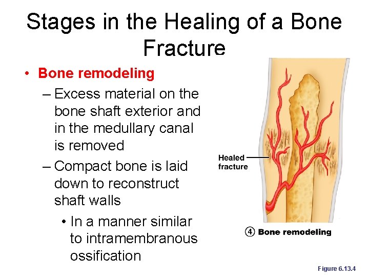 Stages in the Healing of a Bone Fracture • Bone remodeling – Excess material