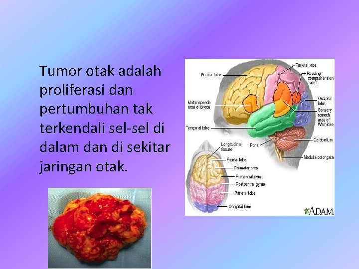 Tumor otak adalah proliferasi dan pertumbuhan tak terkendali sel-sel di dalam dan di sekitar