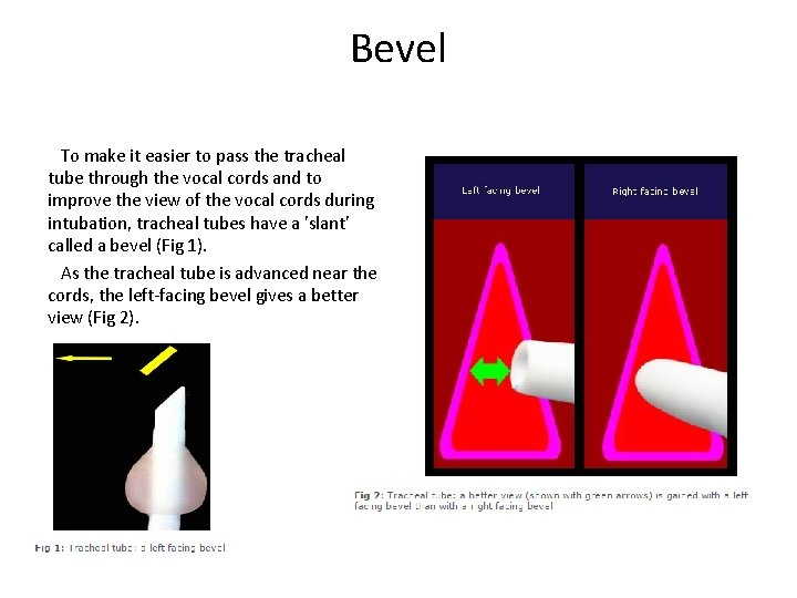Bevel To make it easier to pass the tracheal tube through the vocal cords Bevel To make it easier to pass the tracheal tube through the vocal cords