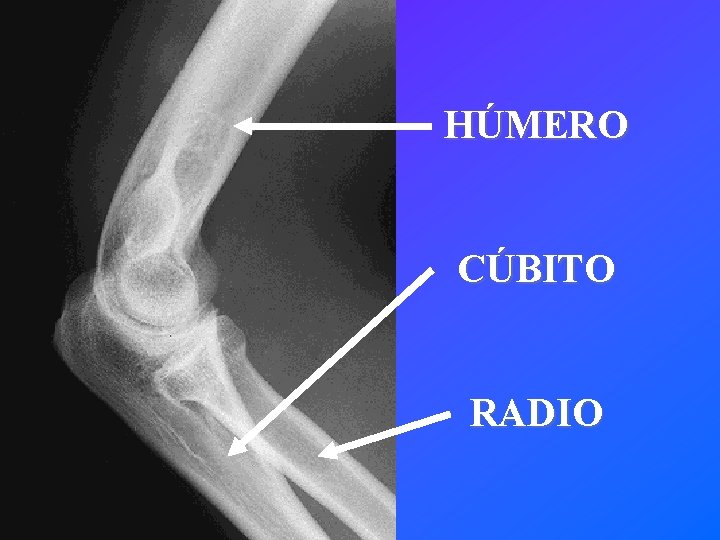 HÚMERO CÚBITO RADIO 