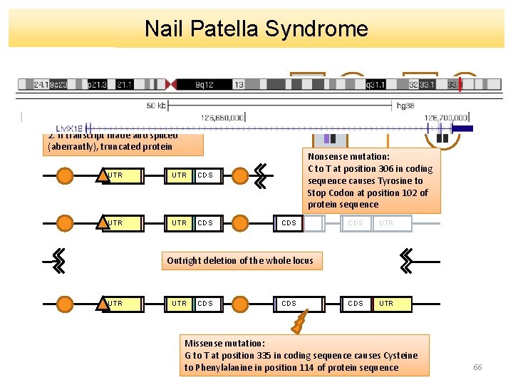 Nail Patella Syndrome Partial deletion downstream of promoter causes either: 1. Transcript degraded 2.