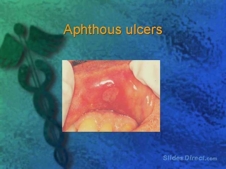 Aphthous ulcers 