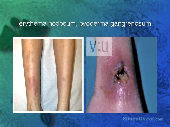 erythema nodosum, pyoderma gangrenosum 