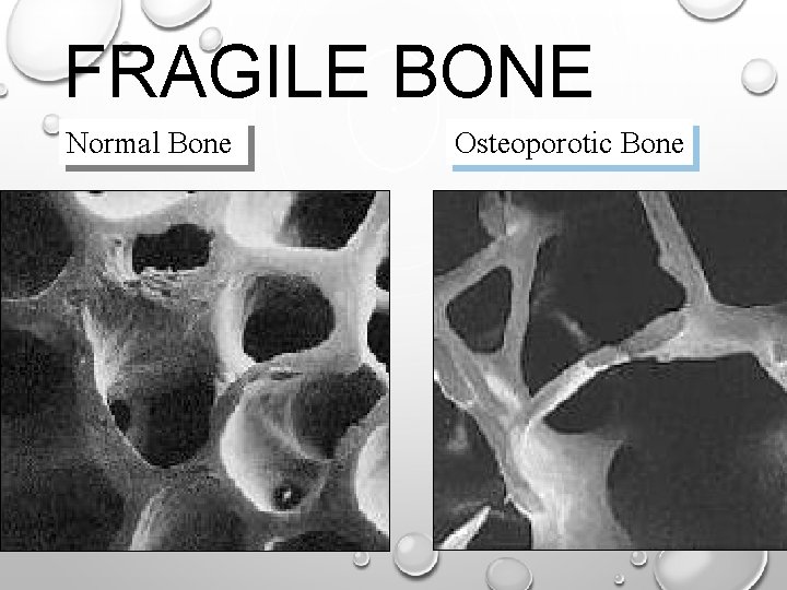 FRAGILE BONE Normal Bone Osteoporotic Bone 