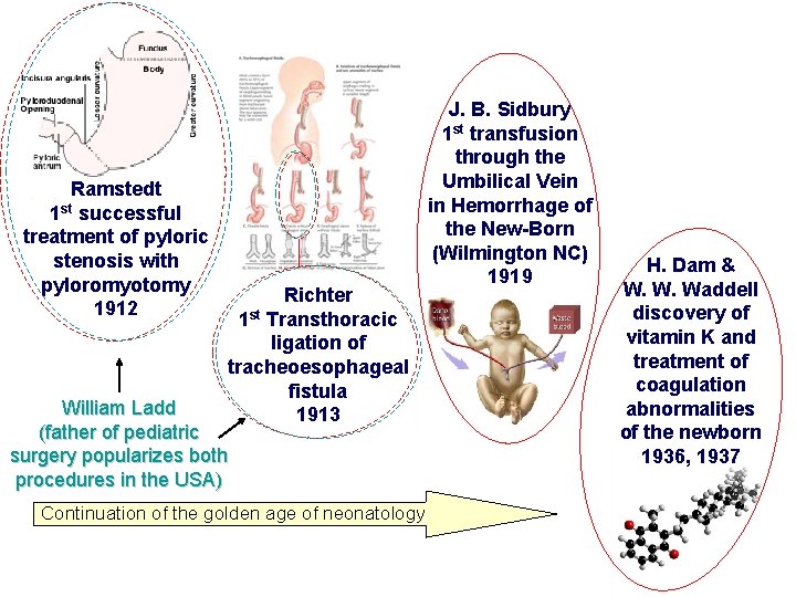 Ramstedt 1 st successful treatment of pyloric stenosis with pyloromyotomy 1912 Richter 1 st