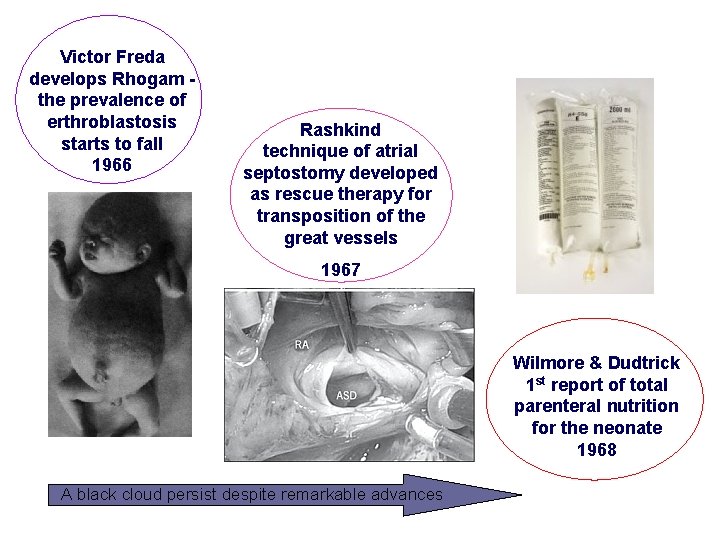 Victor Freda develops Rhogam the prevalence of erthroblastosis starts to fall 1966 Rashkind technique