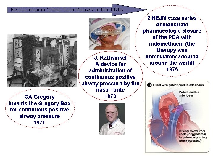 NICUs become “Chest Tube Meccas” in the 1970 s GA Gregory invents the Gregory