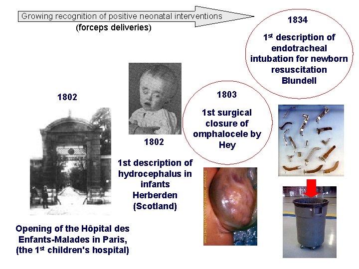 Growing recognition of positive neonatal interventions 1834 (forceps deliveries) 1 st description of endotracheal