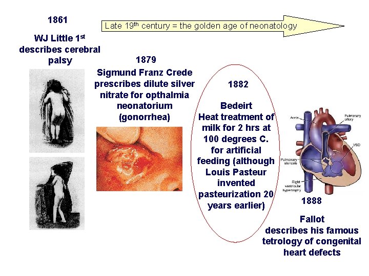 1861 Late 19 th century = the golden age of neonatology WJ Little 1