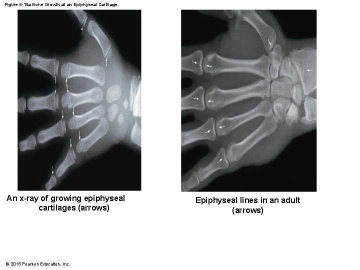 Figure 6 -10 a Bone Growth at an Epiphyseal Cartilage. An x-ray of growing