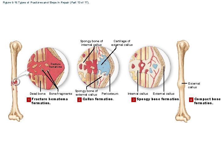 Figure 6 -16 Types of Fractures and Steps in Repair (Part 13 of 17).