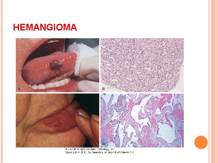 HEMANGIOMA 