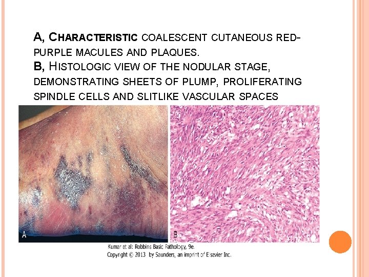 A, CHARACTERISTIC COALESCENT CUTANEOUS REDPURPLE MACULES AND PLAQUES. B, HISTOLOGIC VIEW OF THE NODULAR