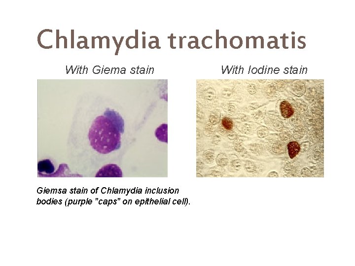 Chlamydia trachomatis With Giema stain Giemsa stain of Chlamydia inclusion bodies (purple "caps" on