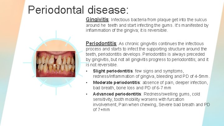 Periodontal disease: Gingivitis: Infectious bacteria from plaque get into the sulcus around he teeth