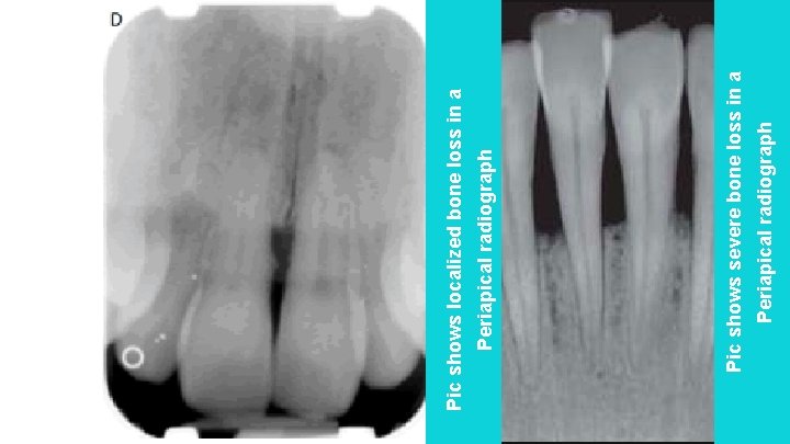 Periapical radiograph Pic shows severe bone loss in a Periapical radiograph Pic shows localized