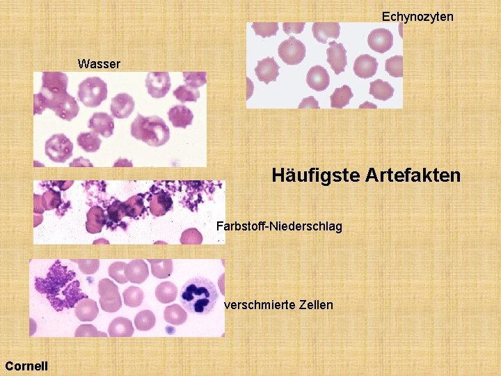 Echynozyten Wasser Häufigste Artefakten Farbstoff-Niederschlag verschmierte Zellen Cornell 