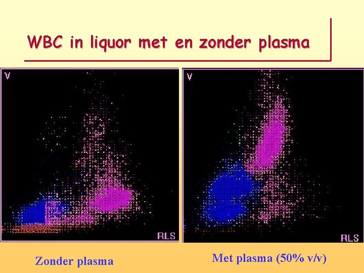 WBC in liquor met en zonder plasma Zonder plasma Met plasma (50% v/v) 