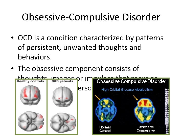 Obsessive-Compulsive Disorder • OCD is a condition characterized by patterns of persistent, unwanted thoughts