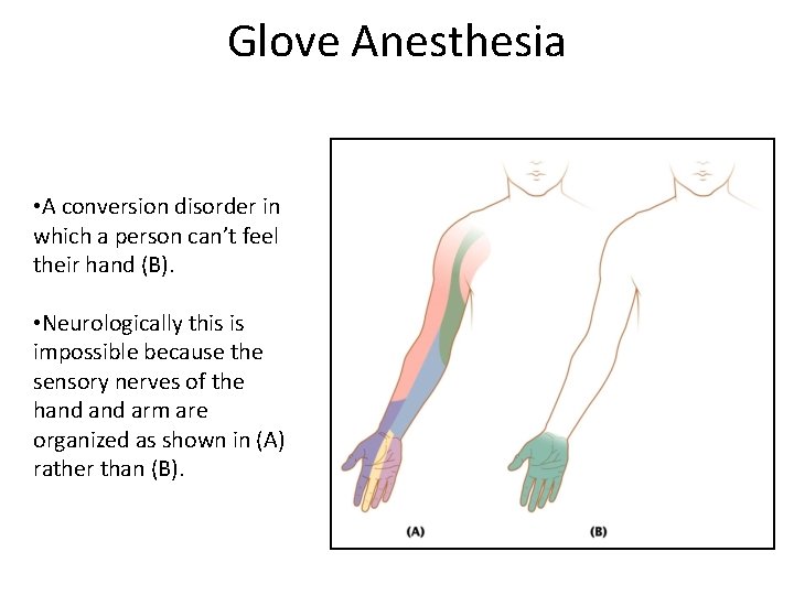 Glove Anesthesia • A conversion disorder in which a person can’t feel their hand