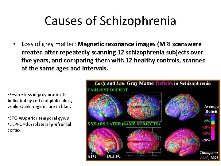 Causes of Schizophrenia • Loss of grey matter: Magnetic resonance images (MRI scanswere created