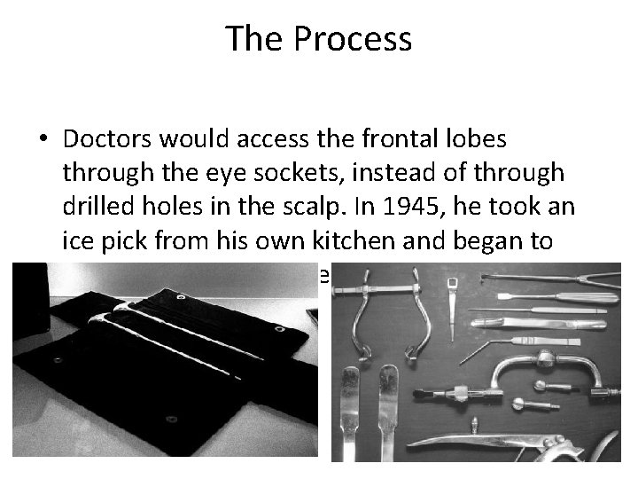 The Process • Doctors would access the frontal lobes through the eye sockets, instead