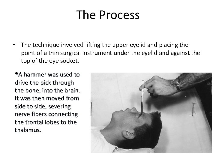 The Process • The technique involved lifting the upper eyelid and placing the point