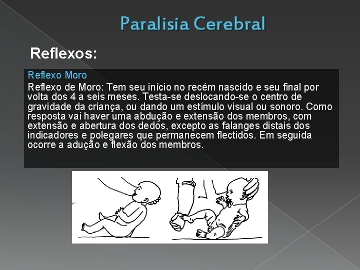 Paralisia Cerebral Reflexos: Reflexo Moro Reflexo de Moro: Tem seu início no recém nascido