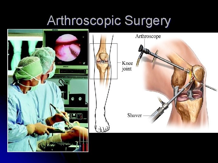 Arthroscopic Surgery 