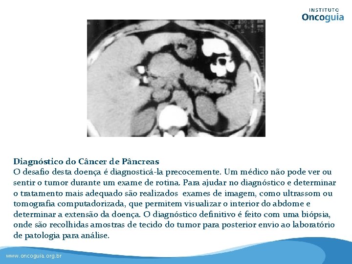 Diagnóstico do Câncer de Pâncreas O desafio desta doença é diagnosticá-la precocemente. Um médico