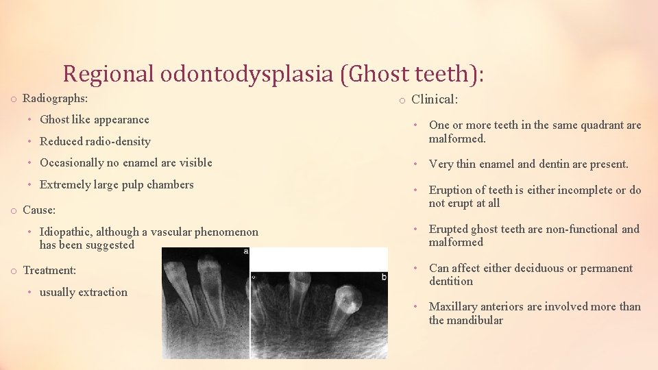 Regional odontodysplasia (Ghost teeth): o Radiographs: • Ghost like appearance • Reduced radio-density o